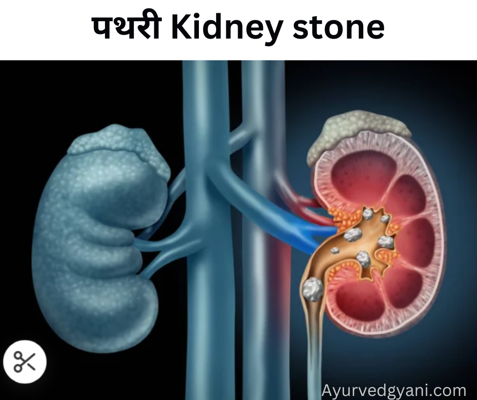 पथरी Kidney stone : कारण, लक्षण, और 15 घरेलू उपाय