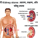 पथरी Kidney stone : कारण, लक्षण, और 15 घरेलू उपाय