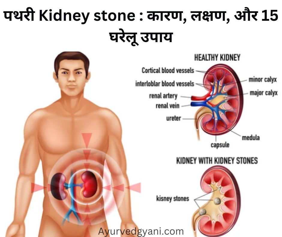 पथरी Kidney stone : कारण, लक्षण, और 15 घरेलू उपाय