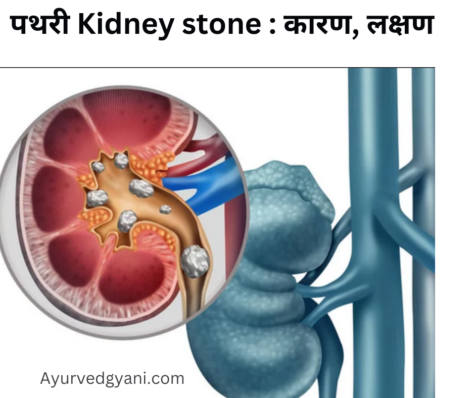 पथरी Kidney stone : कारण, लक्षण, और 15 घरेलू उपाय