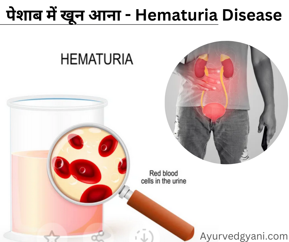 पेशाब में खून आना - हेमैटूरिया Hematuria : कारण,लक्षण और 5 उपचार