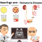 पेशाब में खून आना - हेमैटूरिया Hematuria : कारण,लक्षण और 5 उपचार