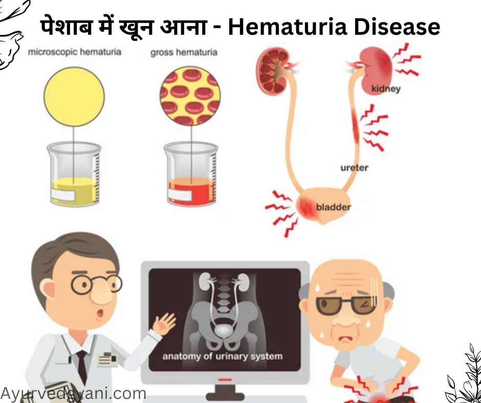 पेशाब में खून आना – हेमैटूरिया Hematuria : लक्षण, निदान और 5 उपचार