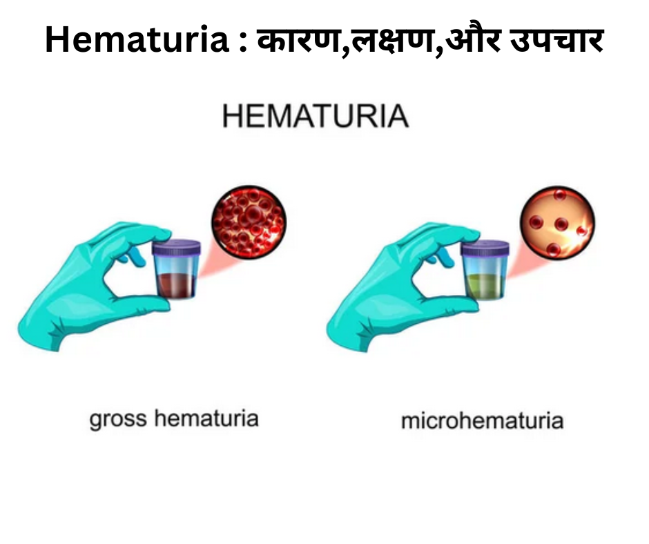 पेशाब में खून आना - हेमैटूरिया Hematuria : कारण,लक्षण और 5 उपचार