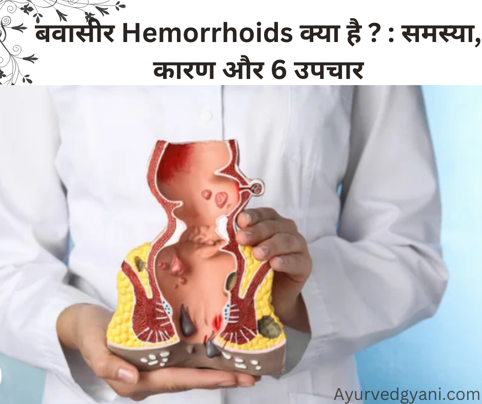 बवासीर Hemorrhoids क्या है     समस्या, कारण और 6 उपचार