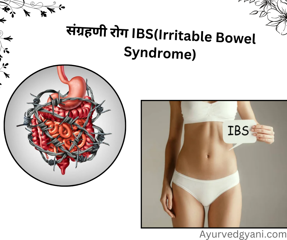 संग्रहणी रोग IBS(Irritable Bowel Syndrome)  लक्षण, उपचार और 20 घरेलू उपाय 