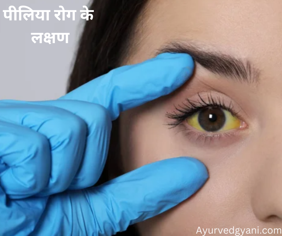 पीलिया रोग jaundice के लक्षण