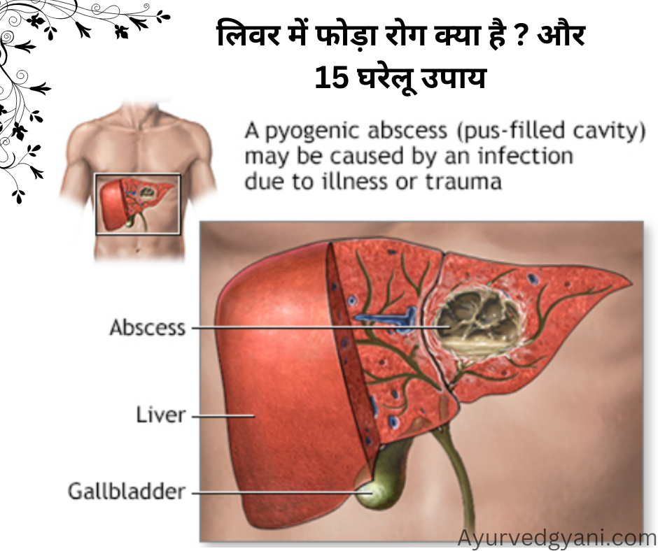 लिवर में फोड़ा liver abscess रोग क्या है ? - लक्षण कारण और 15 घरेलू उपाय