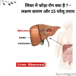 लिवर में फोड़ा liver abscess रोग क्या है ? - लक्षण कारण और 15 घरेलू उपाय