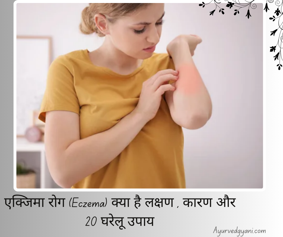 एक्जिमा रोग (Eczema) क्या है? - लक्षण , कारण और 20 घरेलू उपाय