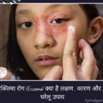 एक्जिमा रोग (Eczema) क्या है लक्षण , कारण और 20 घरेलू उपाय