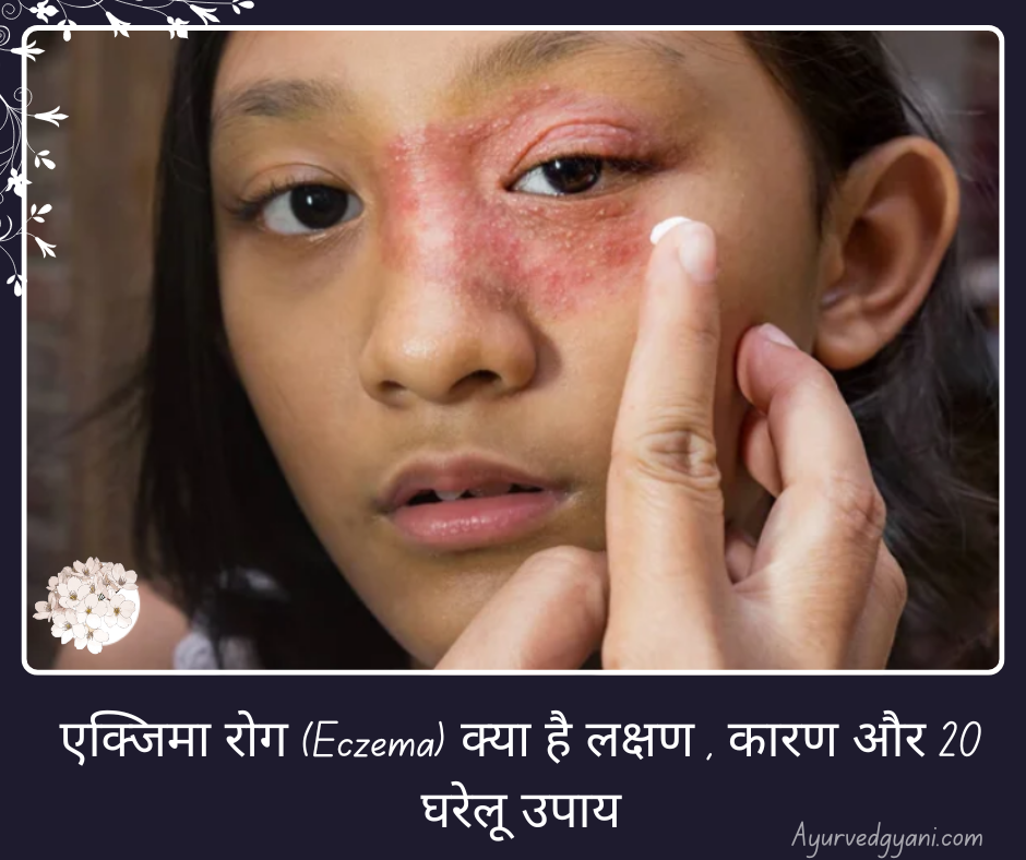 एक्जिमा रोग (Eczema) क्या है लक्षण , कारण और 20 घरेलू उपाय