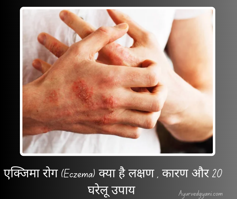 एक्जिमा रोग (Eczema) क्या है? - लक्षण , कारण और 20 घरेलू उपाय