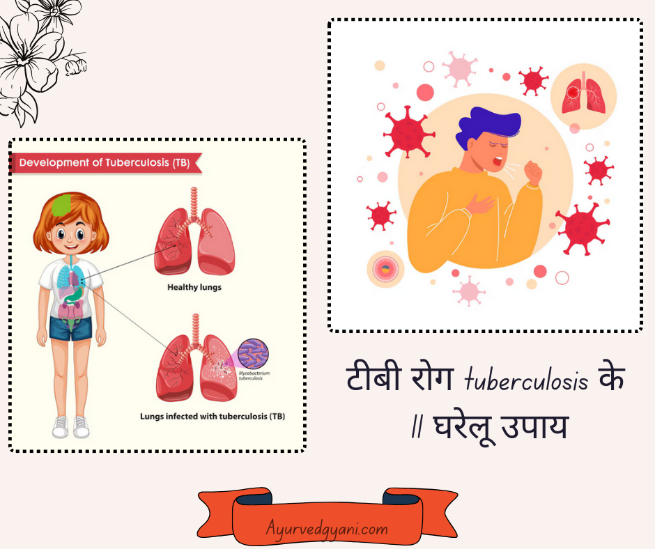 टीबी रोग tuberculosis के 11 घरेलू उपाय