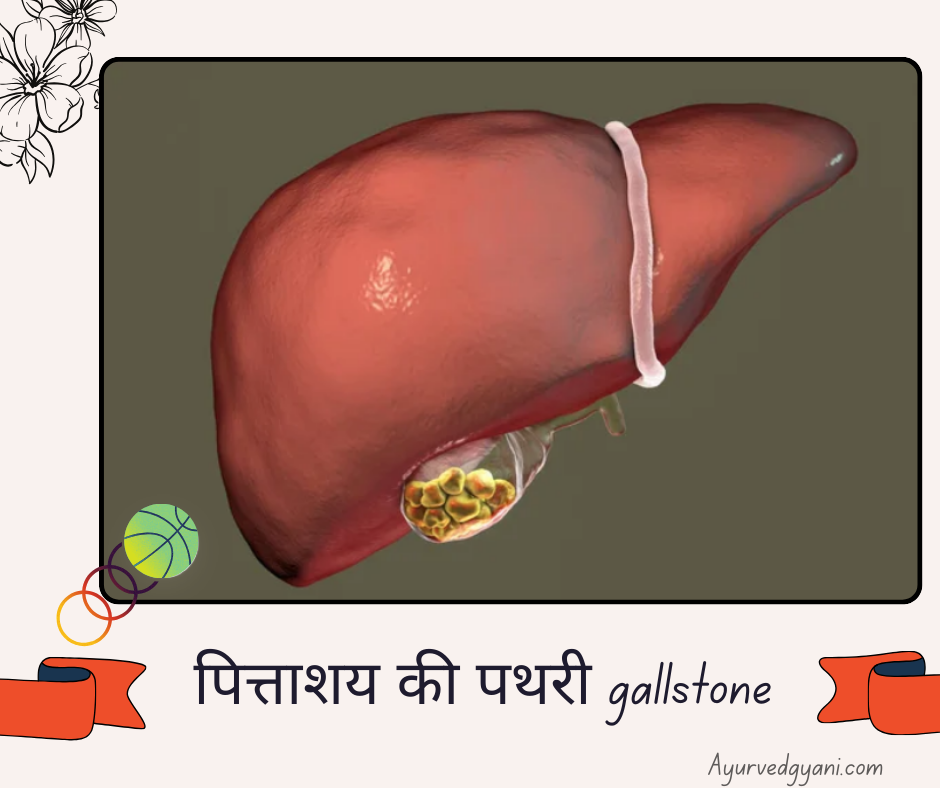 पित्ताशय की पथरी gallstone   समस्या और 3 उपचार