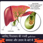 पित्ताशय की पथरी gallstone समस्या और 3 उपचार