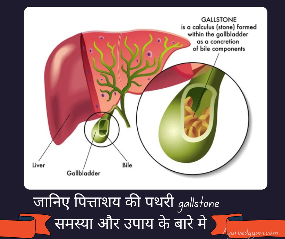 पित्ताशय की पथरी gallstone समस्या और 3 उपचार