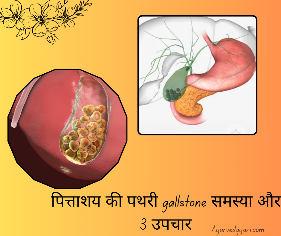 पित्ताशय की पथरी gallstone   समस्या और 3 उपचार