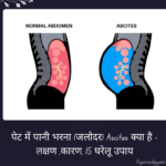 पेट में पानी भरना (जलोदर) Ascites क्या है - लक्षण ,कारण, 15 घरेलू उपाय