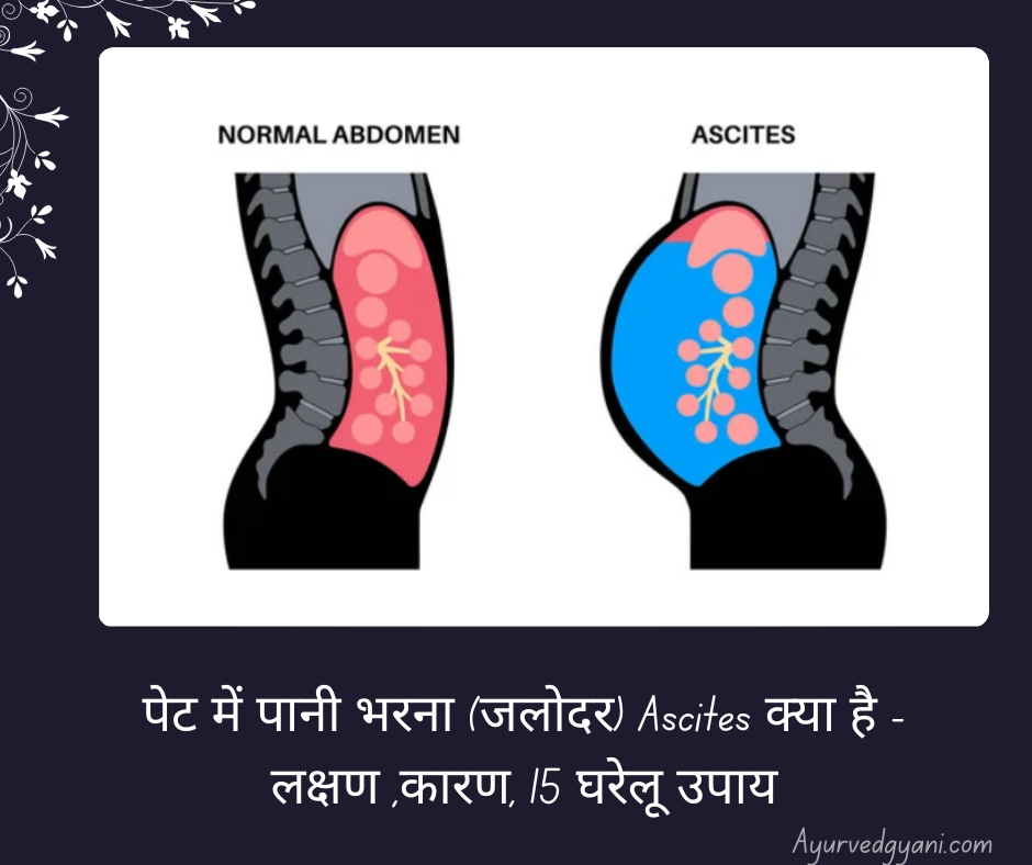 पेट में पानी भरना (जलोदर) Ascites क्या है - लक्षण ,कारण, 15 घरेलू उपाय